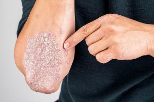 CBD for Psoriasis Does it Work